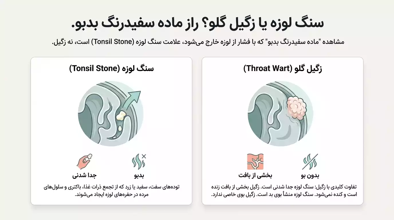 تفاوت سنگ لوزه و زگیل دهانی