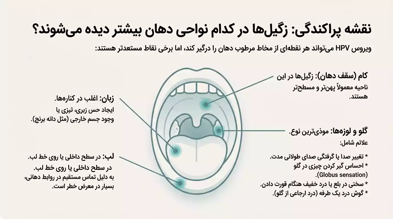 زگیل دهانی در کدام قسمتهای دهان بیشتر ایجاد میشود؟