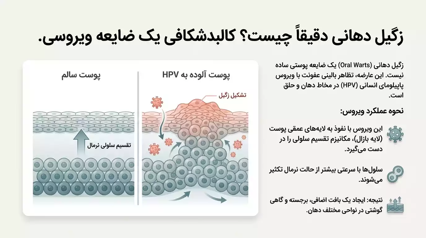 زگیل دهانی چیست و چگونه باعث بیماری زایی میشود؟