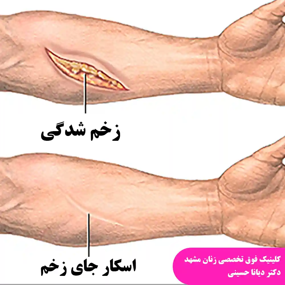 اسکار زخم - کلینیک زنان دکتر دیانا حسینی