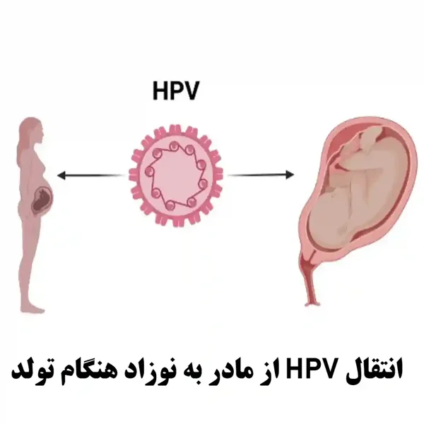 انتقال HPV از مادر به نوزاد در بدو تولد