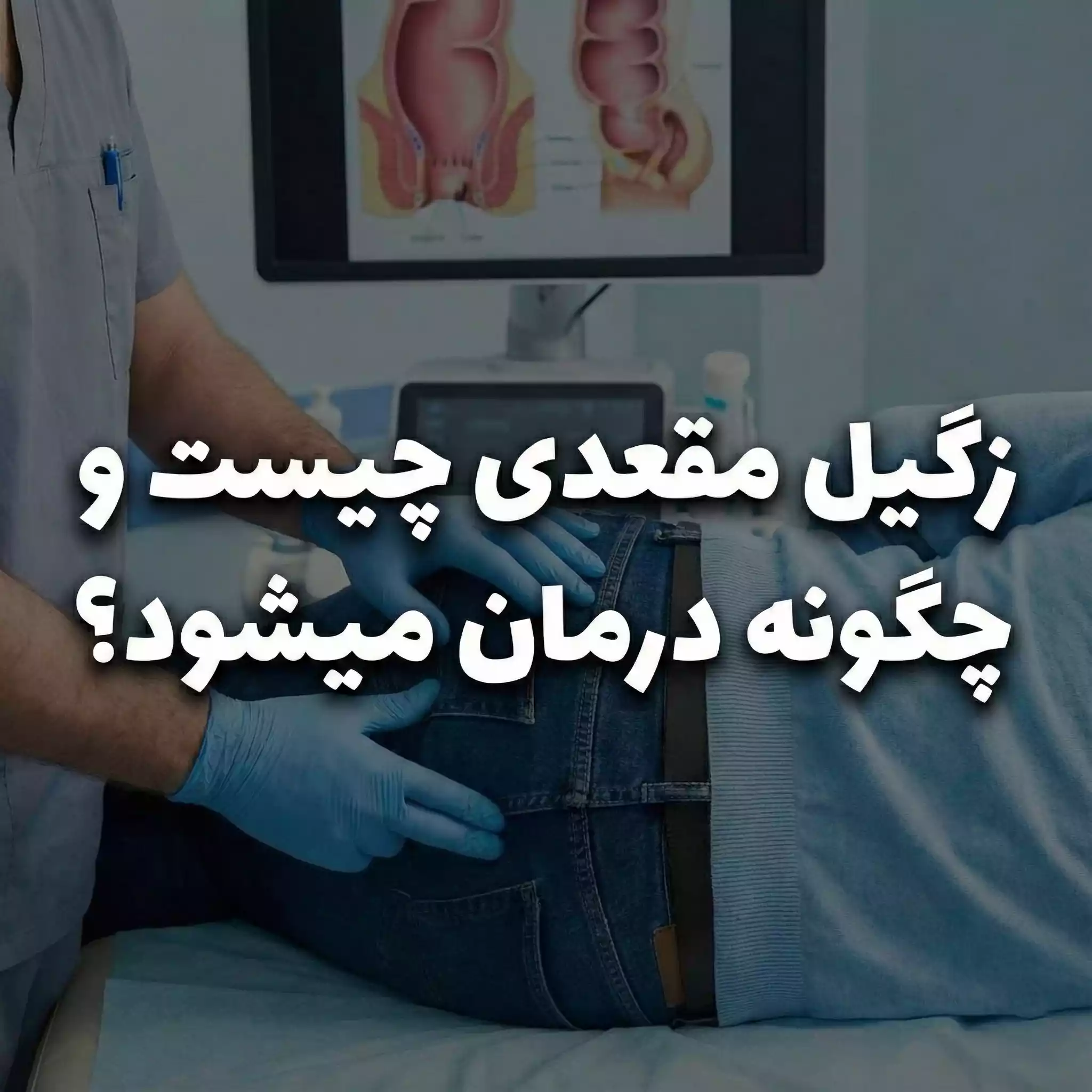 زگیل مقعد چیست و چگونه درمان میشود؟
