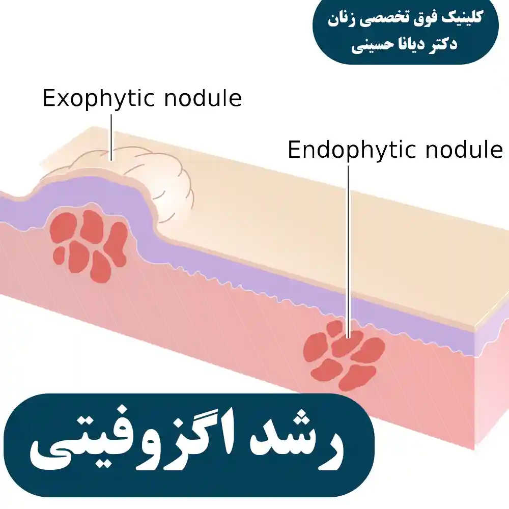 رشد اگزوفیتیک