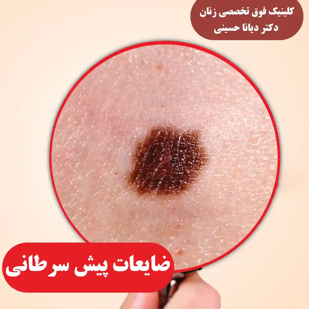 ضایعات پیش سرطانی