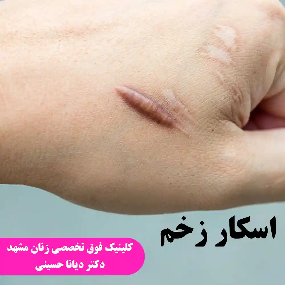 اسکار زخم