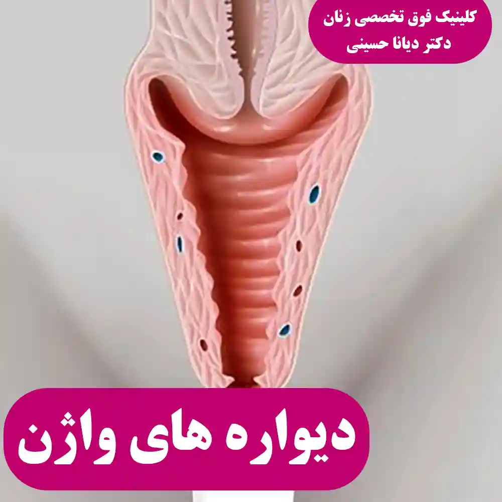 دیواره های واژن