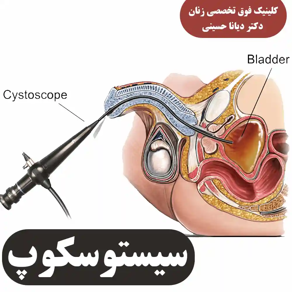 سیستوسکوپ