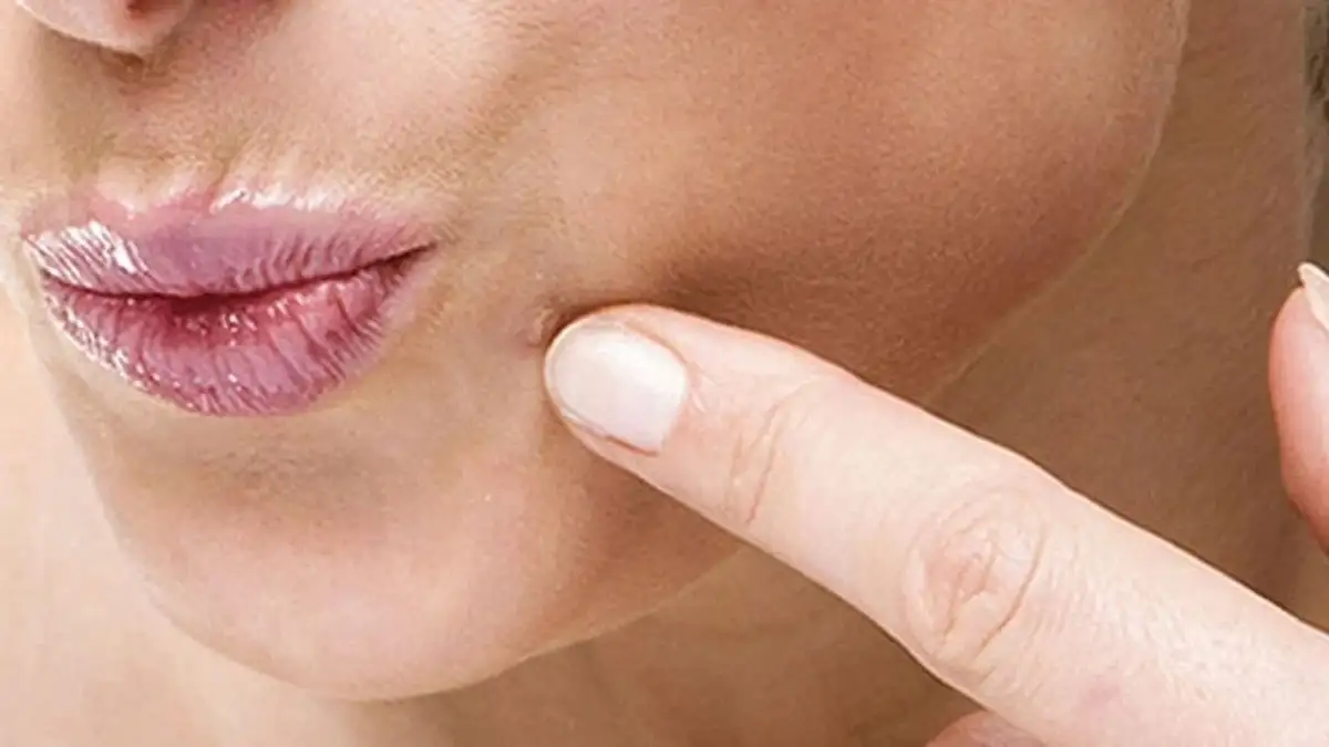 زگیل تناسلی دهانی چیست و چه علائمی دارد؟