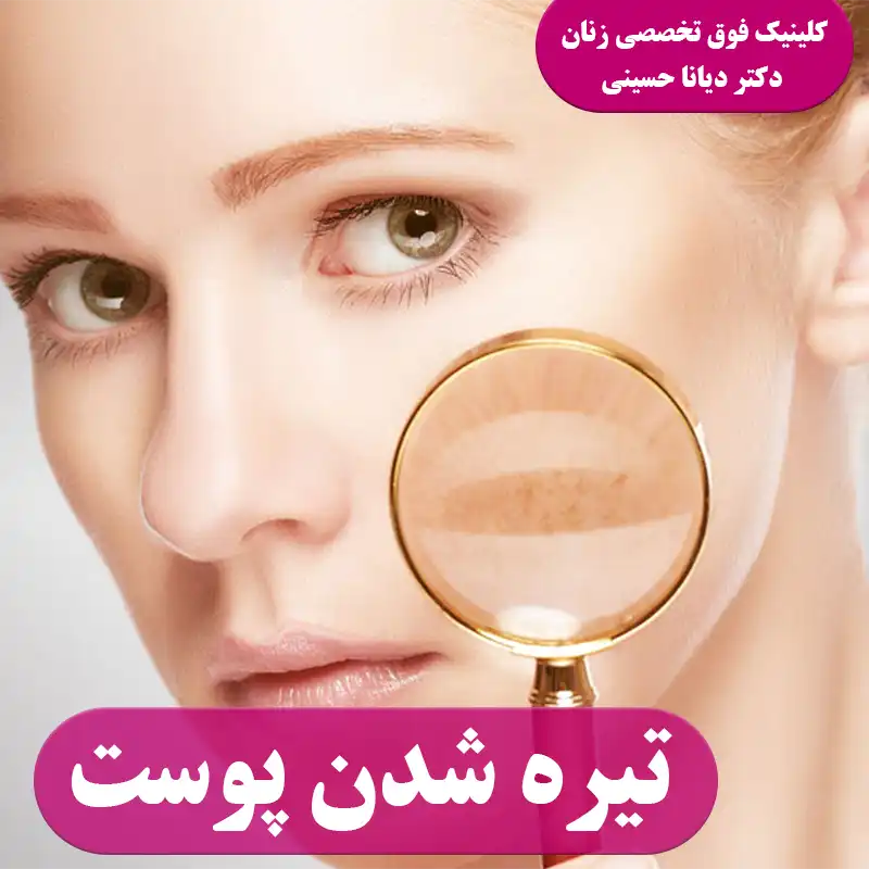 تیره شدن پوست