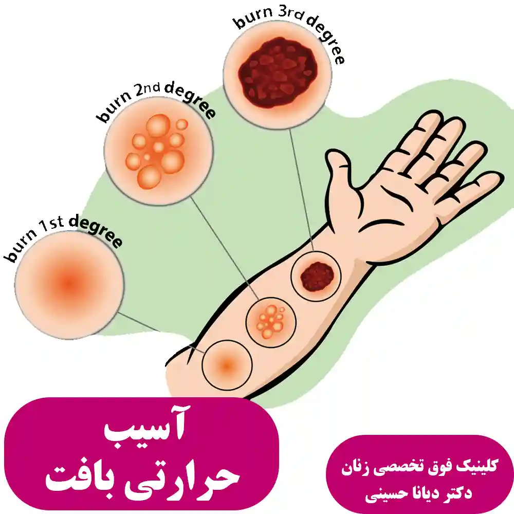 آسیب حرارتی بافت