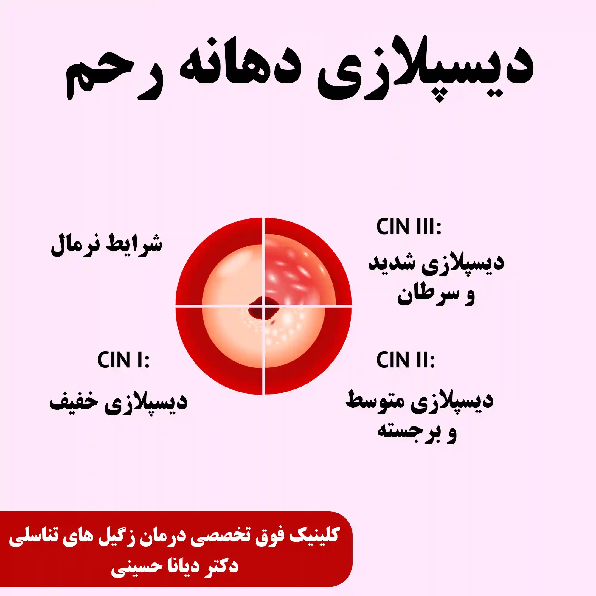 دیسپلازی دهانه رحم